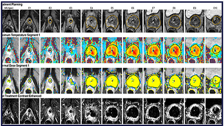 Magnetic Resonance Imaging-guided Transurethral Ultrasound Ablation (TULSA) of Localized Prostate Cancer: A prospective Trial