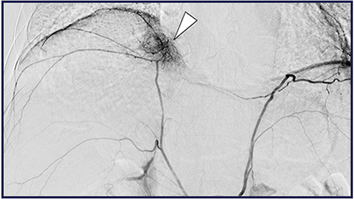 High-Dose Radioembolization Limited by Lung Shunt for Hepatocellular Carcinoma Supplied by the Inferior Phrenic Artery
